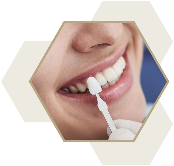 Teeth whitening Milton Keynes