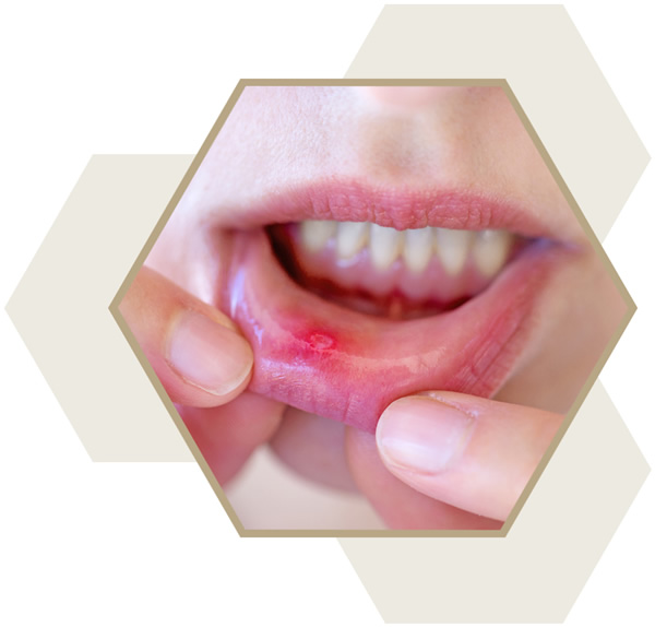 Treatment for mouth ulcers at The Hub Milton Keynes