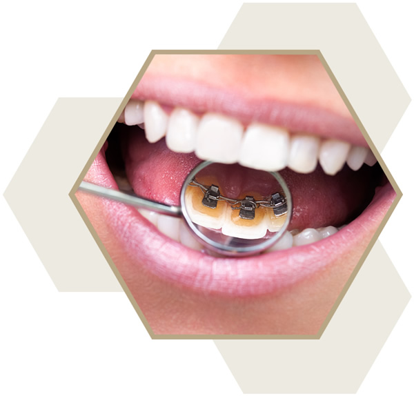 Lingual Braces Near Me, Milton Keynes Orthodontists
