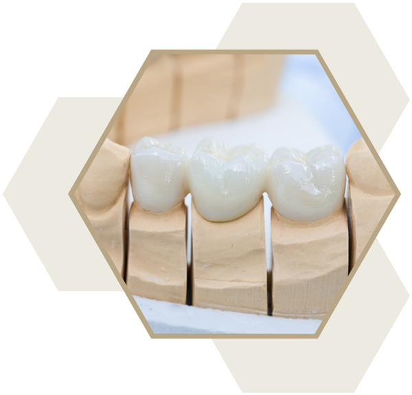 Dental bridges at The Hub Milton Keynes