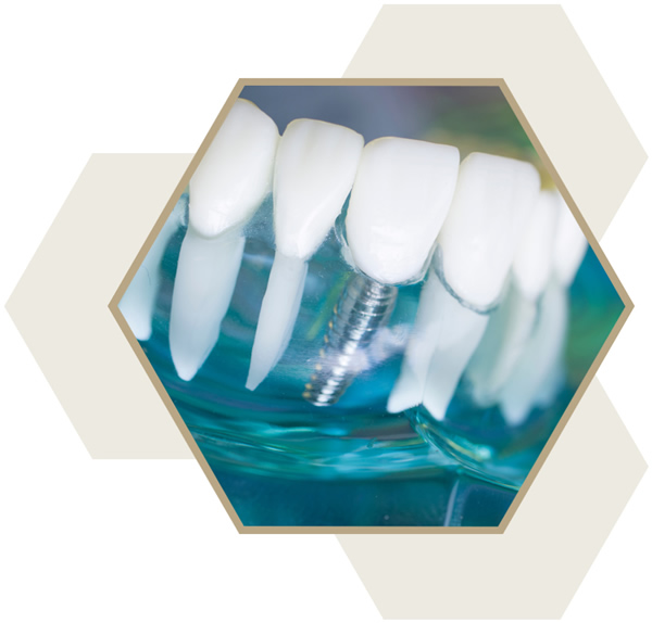 Dental implant Milton Keynes