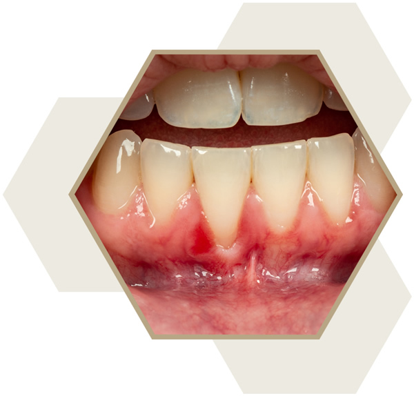 periodontal laser treatment near me