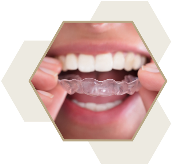 Teeth grinding solutions at The Hub Milton Keynes