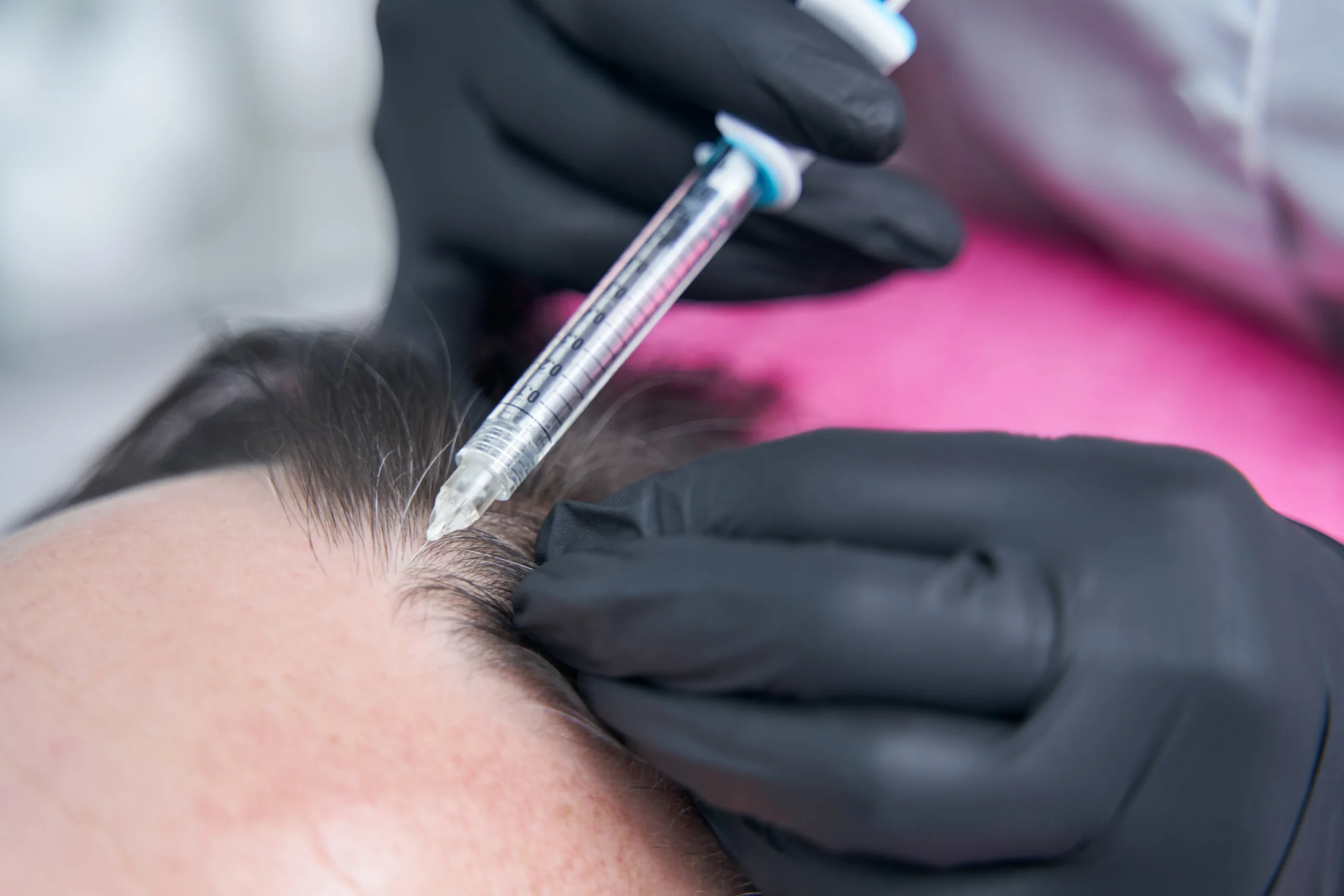 Skin regeneration with Plinest treatment hair