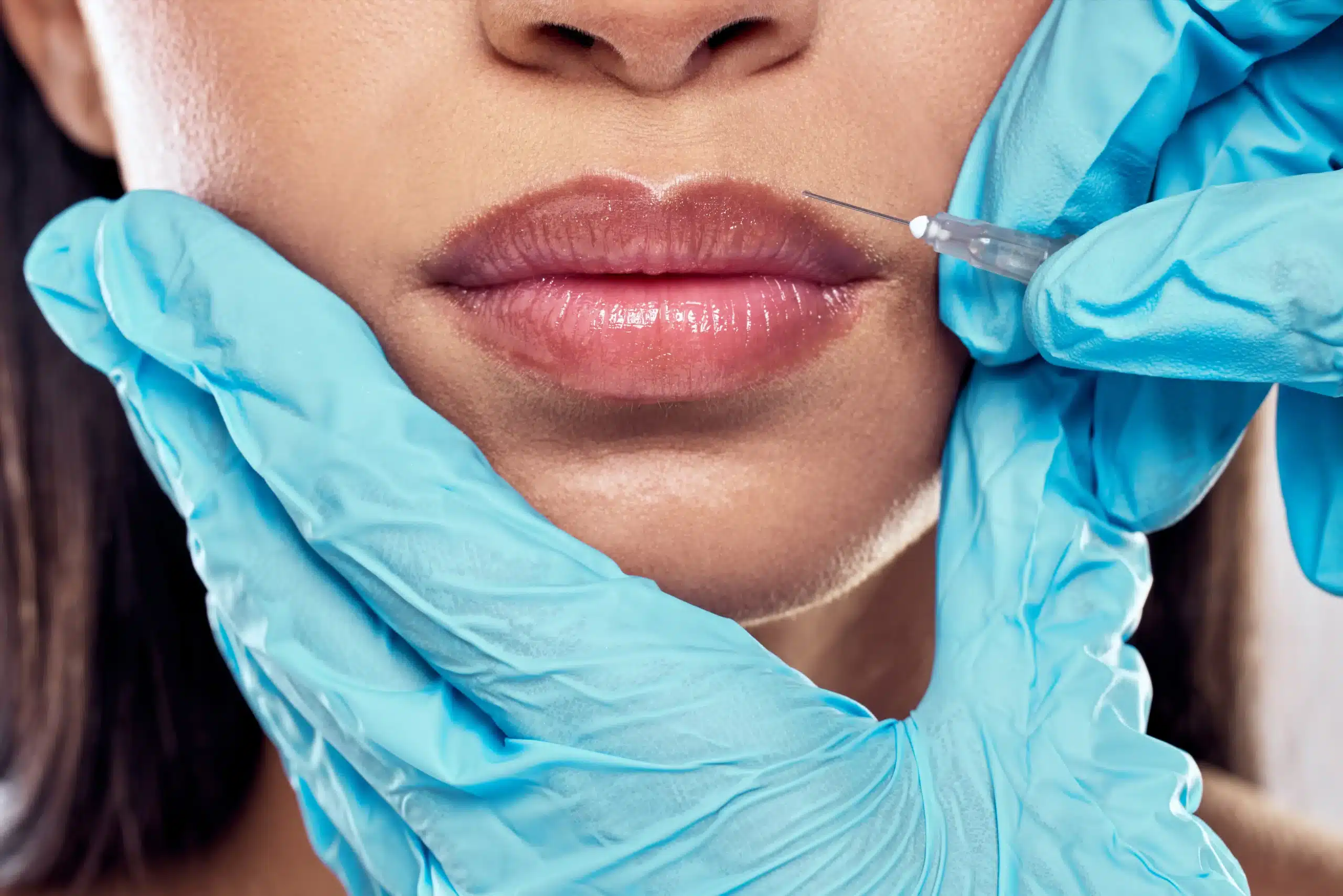woman about to have lips filler with dr gul