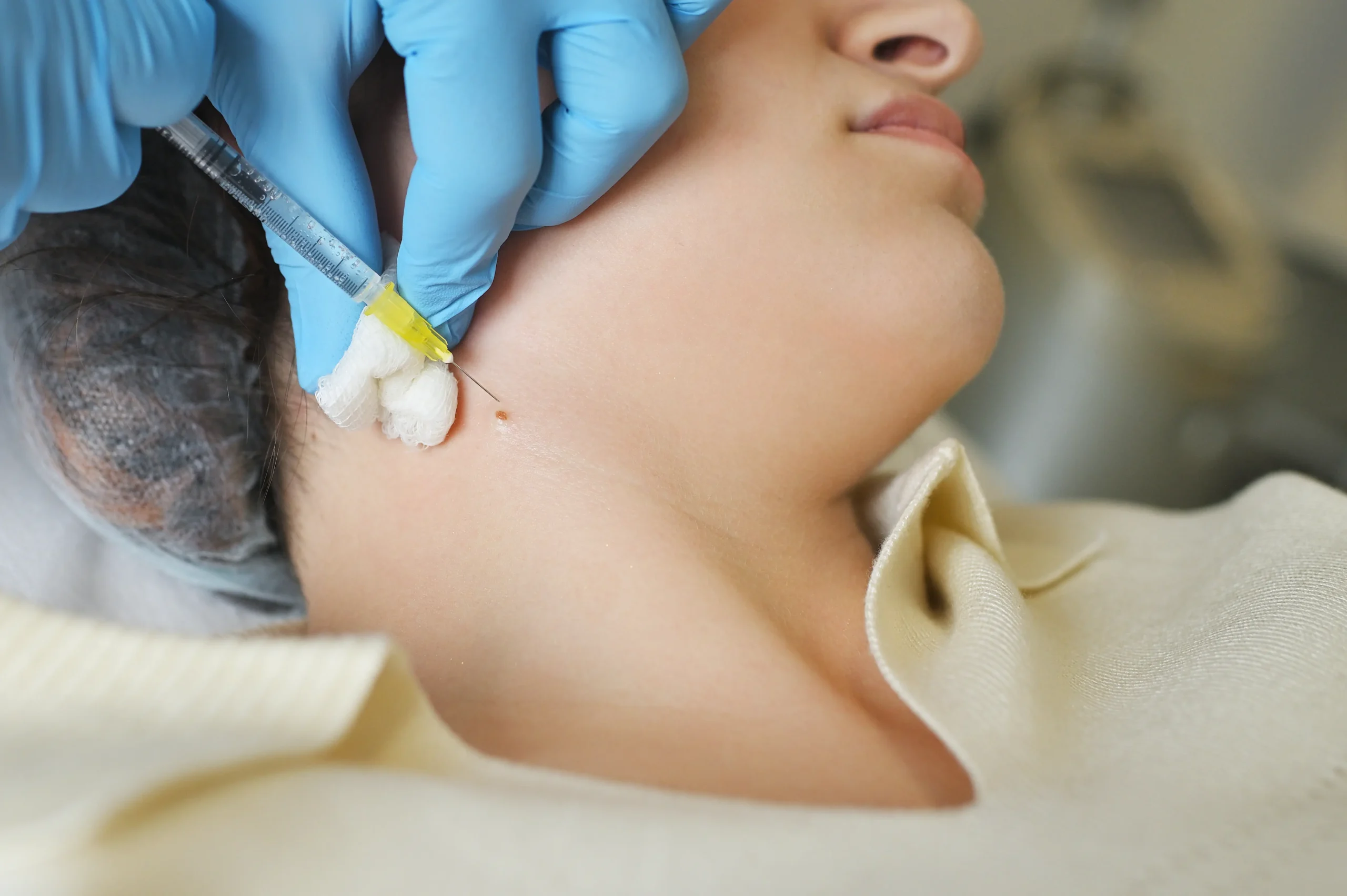 Profhilo treatment for neck tightening in Milton Keynes